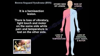 Brown Sequard Syndrome  Everything You Need To Know  Dr Nabil [upl. by Aiksas]