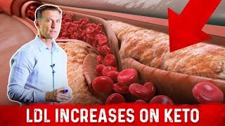 Cardiologist Dr Nadir Ali Explains LDL Bad Cholesterol Spike With Keto – DrBerg [upl. by Hibbitts101]