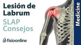 Consejos para solucionar la lesión labrum de hombro SLAP [upl. by Vogel]