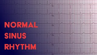 Normal Sinus Rhythm  EKG ECG Interpretation [upl. by Nosnehpets]