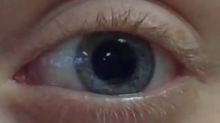 Introducing the Dilating Pupil [upl. by Cox]