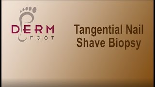 Tangential Nail Shave Biopsy  DERMfoot faculty  Bryan Markinson [upl. by Yllor]