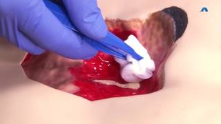 How to Clean a Wound PostSurgery  BandAid® Brand of First Aid Products [upl. by Salter968]