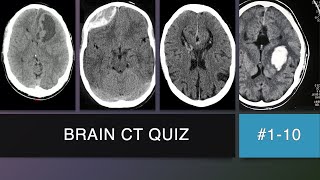 Brain CT Scan Quiz 1  10 [upl. by Rebecka]