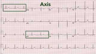 ECG interpretation recognising normal [upl. by Delaryd]