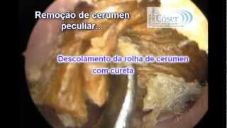 The Biggest Earwax removal by otoendoscopic technique everA Maior cera de ouvido do mundo [upl. by Ronalda886]