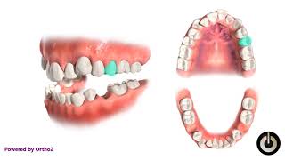 4 Second Premolar Extraction  Dental Braces  Temecula Valley CA [upl. by Lesna]