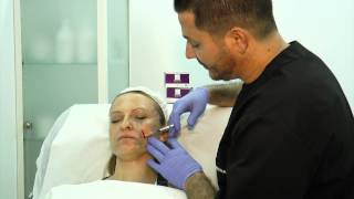 Tratamiento facial con Sculptra [upl. by Baxie346]