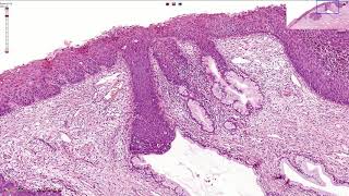 HSIL  High Grade Squamous Intraepithelial Lesion  Histopathology [upl. by Wendi]