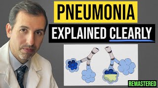 Pneumonia Explained Symptoms Diagnosis Labs Treatment [upl. by Ilzel440]