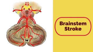 Brainstem Stroke Syndromes [upl. by Llemij]