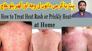 Prickly Heat Treatment  Skin Rash  Red Skin Rash  Miliaria Rubra  Itchy Rash  Sun Allergy [upl. by Omor808]