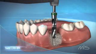 Procedimiento de colocación de implante dental MIS El Salvador [upl. by Onimixam]