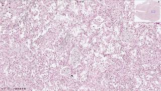 Pneumocystis Jirovecii Pneumonia  Histopathology [upl. by Ambrose]