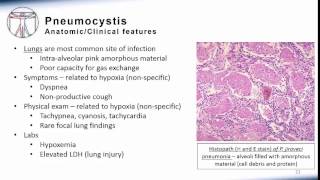 5 Pneumonia Pneumocystis [upl. by Atenahs714]