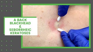 A Back Blackhead amp Seborrheic Keratoses  Dr Derm [upl. by Etteloc402]