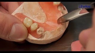 Thermoplastic dentures  Repair and service [upl. by Gunther]