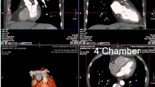 Coronary CT Angiography RCA Stenosis [upl. by Weidar]