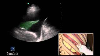 How To Ultrasound Guided Thoracentesis Exam 3D Video [upl. by Manvell]