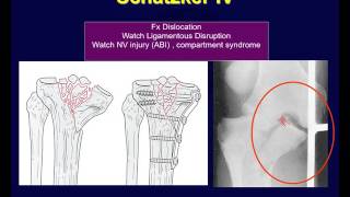 Tibial plateau fractures 2 [upl. by Cheslie]