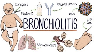 Bronchitis  Acute Bronchitis [upl. by Conrad]