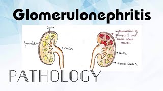 Glomerulonephritis Pathology [upl. by Guyer]