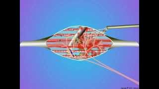 09Trigger Point Dry Needling [upl. by Leuname]