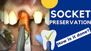 Tooth extraction and SOCKET PRESERVATION  How is it done [upl. by Namyaw245]