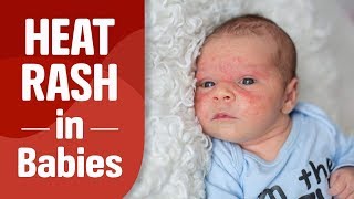 Heat Rash in Babies [upl. by Bobina]