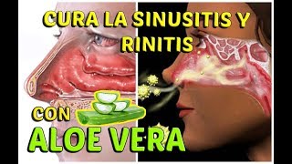 CÓMO CURAR LA SINUSITIS Y RINITIS ALÉRGICA CON ALOE VERA  LifeStyle [upl. by Madelaine]