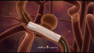 Brain Aneurysm Treatment [upl. by Negem]