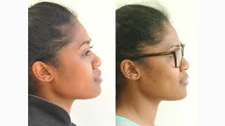 How Orthodontic Extractions can change Facial Profiles [upl. by Normac]